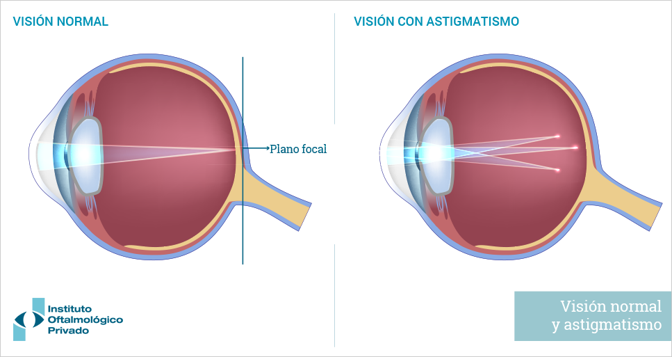 Anatomía del ojo. Visión normal versus astigmatismo.