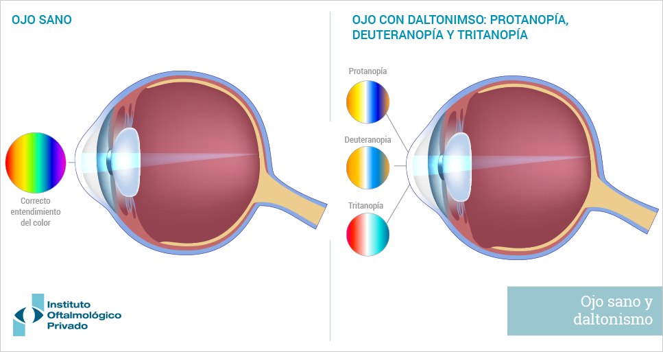 Anatomía del ojo: comparación entre el ojo sano y el ojo daltónico.
