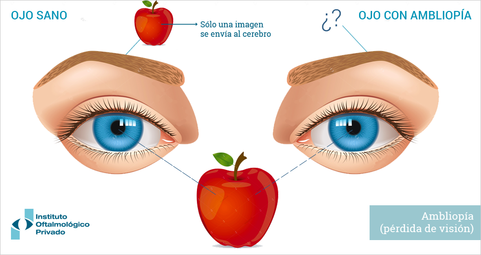 Anatomía del ojo: ambliopía.
