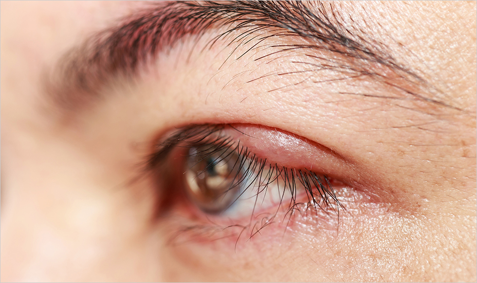 Acercamiento del párpado de un ojo con blefaritis.