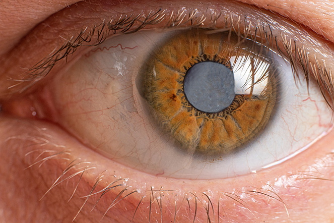 Ojo con catarata visible