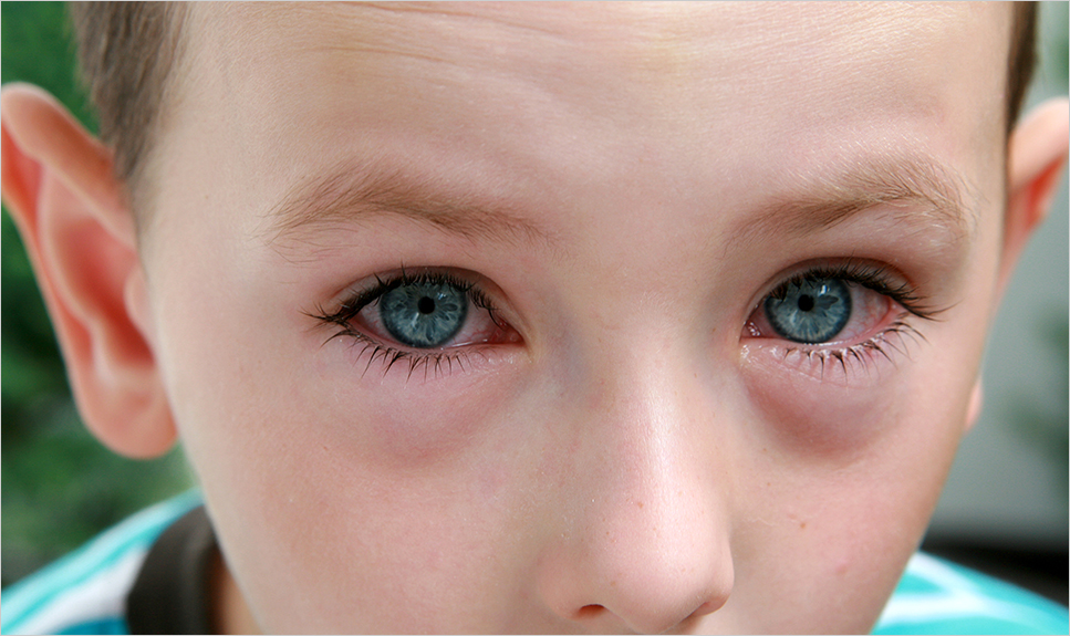 Foto de los ojos de un niño con conjuntivitis.