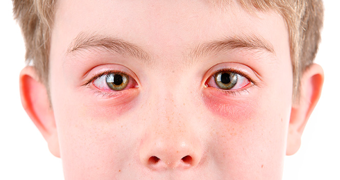 Niño con conjuntivitis