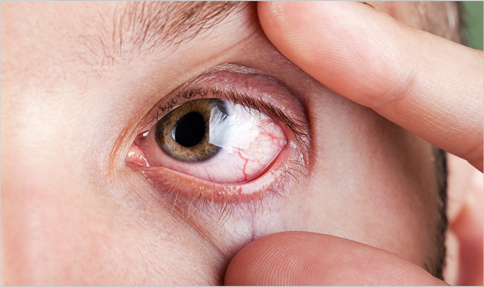 Ojo de hombre con estrabismo.