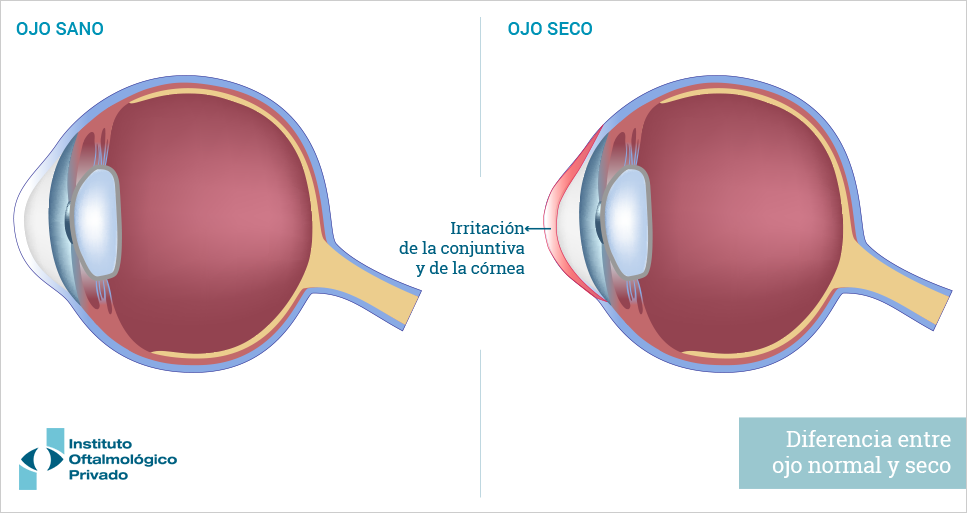 Anatomía del ojo: ojo normal versus ojo seco.