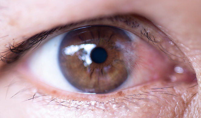 Ejemplo de un ojo con pterigión